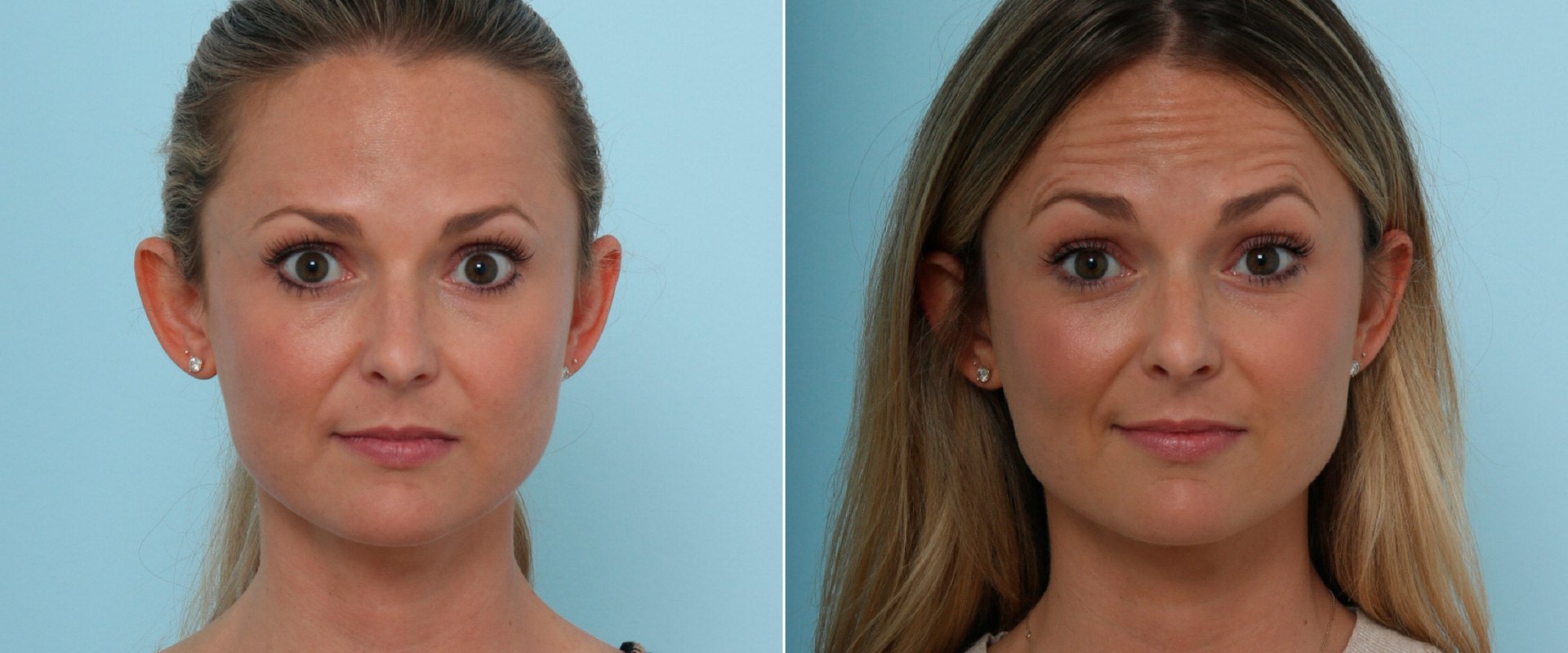 What Happens When You Stop Getting Botox Treatments?