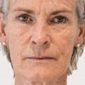 Is Botox or Filler the Best Option for Jowls?