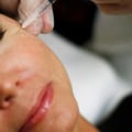 How Much Did Allergan Pay for Botox?