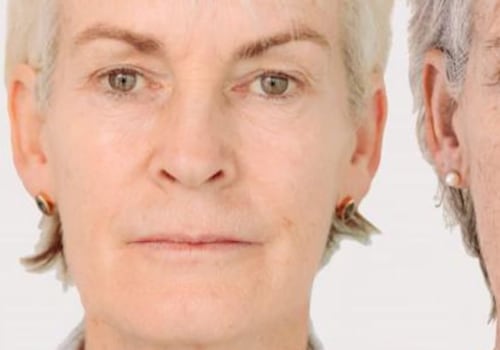 Is Botox or Filler the Best Option for Jowls?
