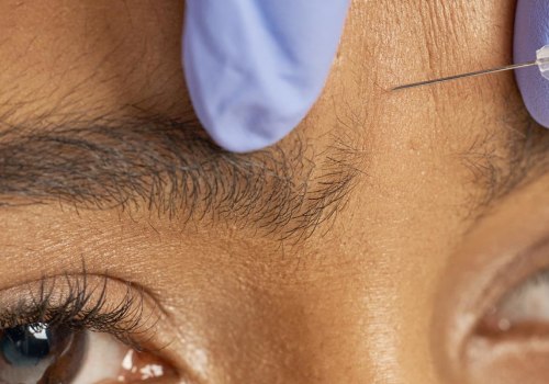 Is Botox Worth the Cost?