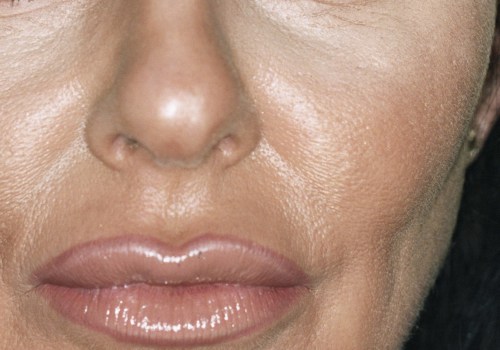 What are the Long-Term Effects of Botox Injections?