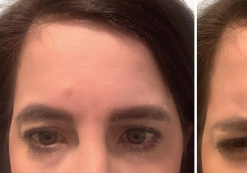 Where Does Botox Make the Most Difference?